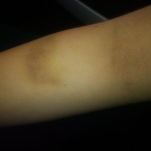 Bruises on arms and legs were caused by male Quest staff, says Celese Boudreau.  Police decided not to pursue the matter. (Photo submitted by Adam Boudreau) 